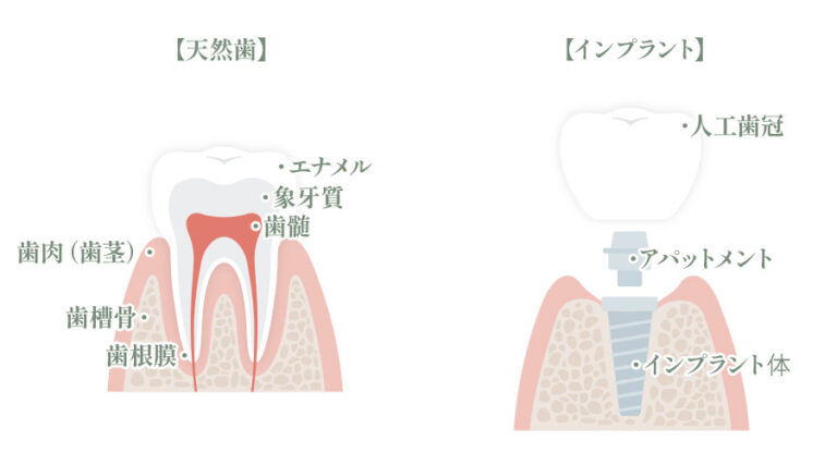 インプラントと天然歯の構造比較